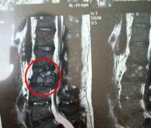 Tumor hrbtenice na sliki