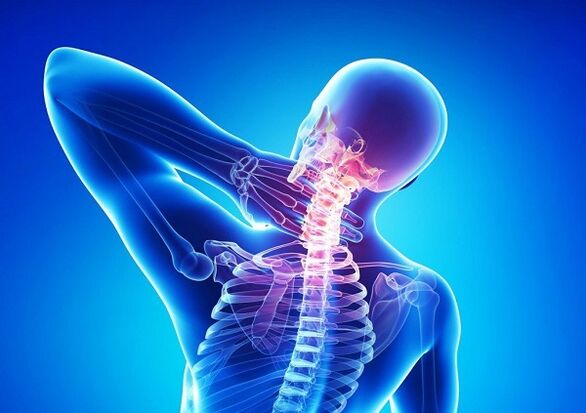 Bolečina v vratni hrbtenici z osteohondrozo