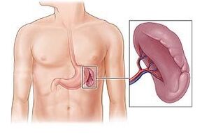 patologija vranice kot vzrok bolečine pod levo lopatico