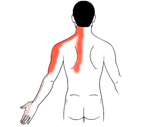 cervikalna osteohondroza kot vzrok bolečine v sklepih prstov