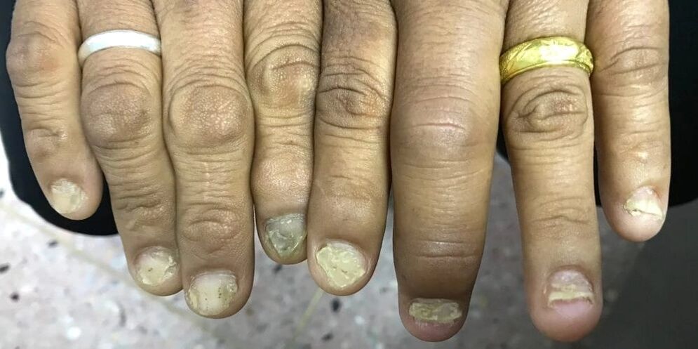 Otekanje prstov in deformacija nohtne plošče lahko kažeta na razvoj psoriatičnega artritisa.